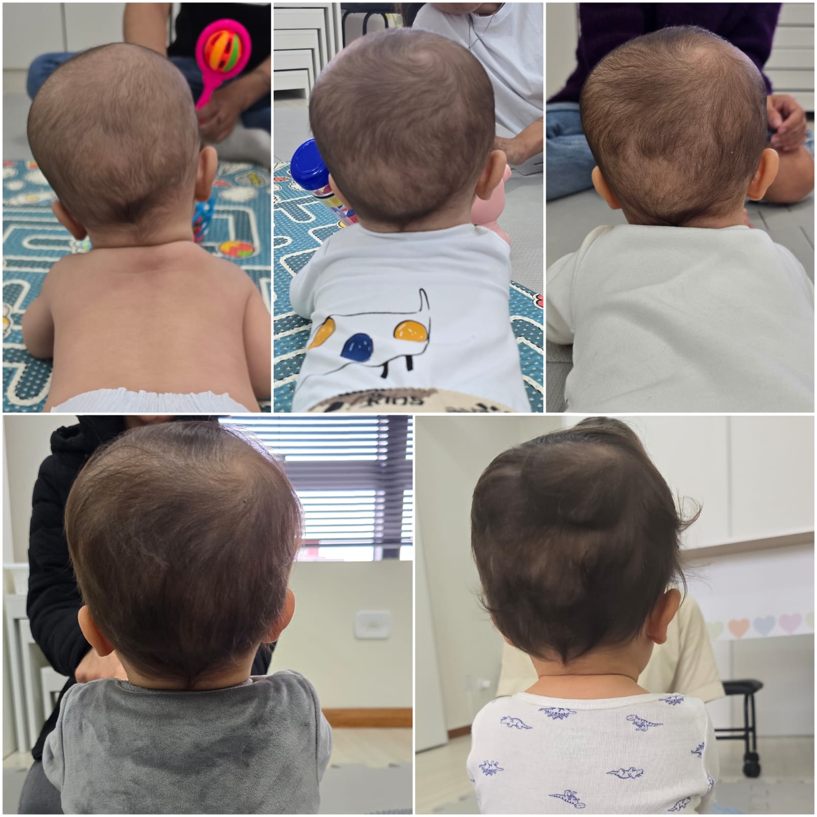 Comparativo da evolução do crânio de bebê em tratamento de torcicolo congênito e assimetria craniana
